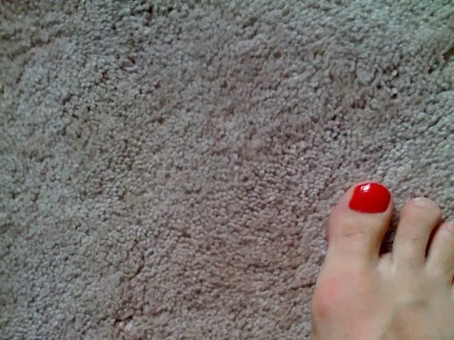 Leg sores identified: Recognizing shingles and other possible sources